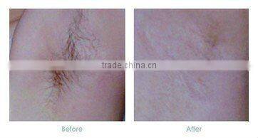IPL machine for hair removal, freckle removal with Memory battery in the handpiece-(FB-A006)
