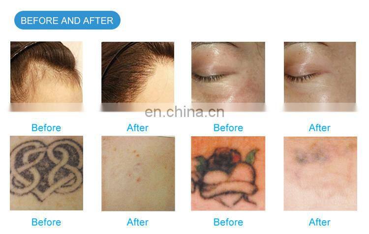 LFS-K3 LEFIS IPL Laser Beauty Equipment/Portable Elight ipl+ND yag laser/ hair removal tattoo removal machine