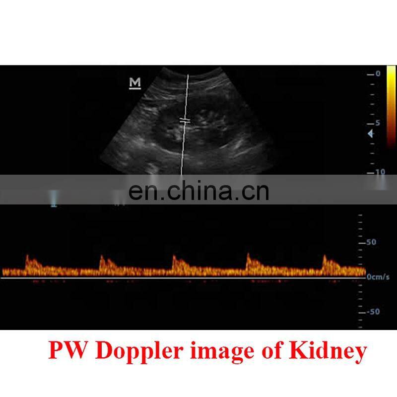 DP-20 Mindray Portable Full Digital Ultrasound Machine Price Mindray Color Ultrasound LED