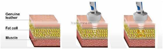 ultrasonic weight loss treatment ultrashape fda