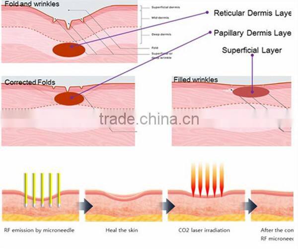 2015 hot selling radiofrecuencia rf portable equipment