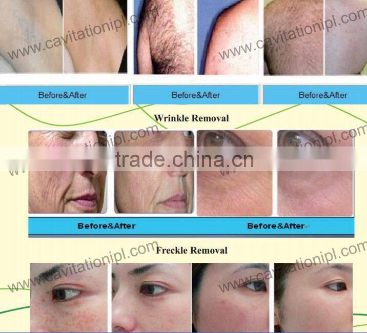Free shipping venus laser ipl hair removal super crystal