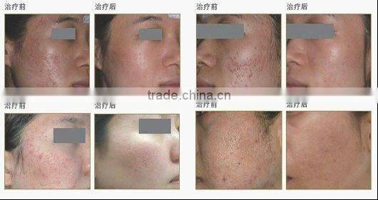 professional C02 laser