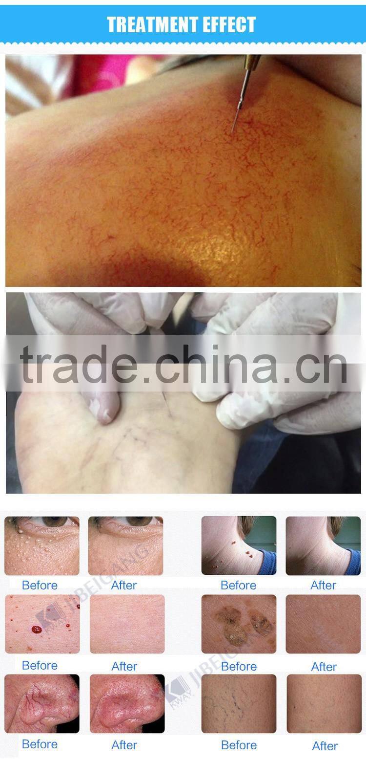 beauty salon use portable 30MHz RF laser blood vessels removal machine
