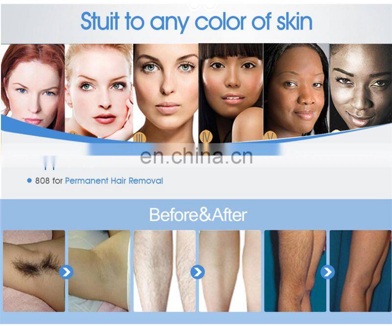 Beauty salon equipment dental nd yag long pulse laser vascular/808nm laser hair removal machine