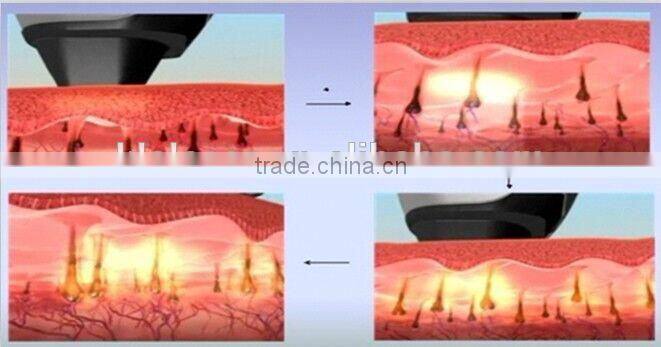 Home laser hair removel, diode 808 laser, 808nm laser hair removal machine