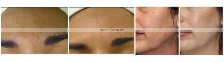 Skin Care professional aqua peel machine diamond dermabrasion equipment