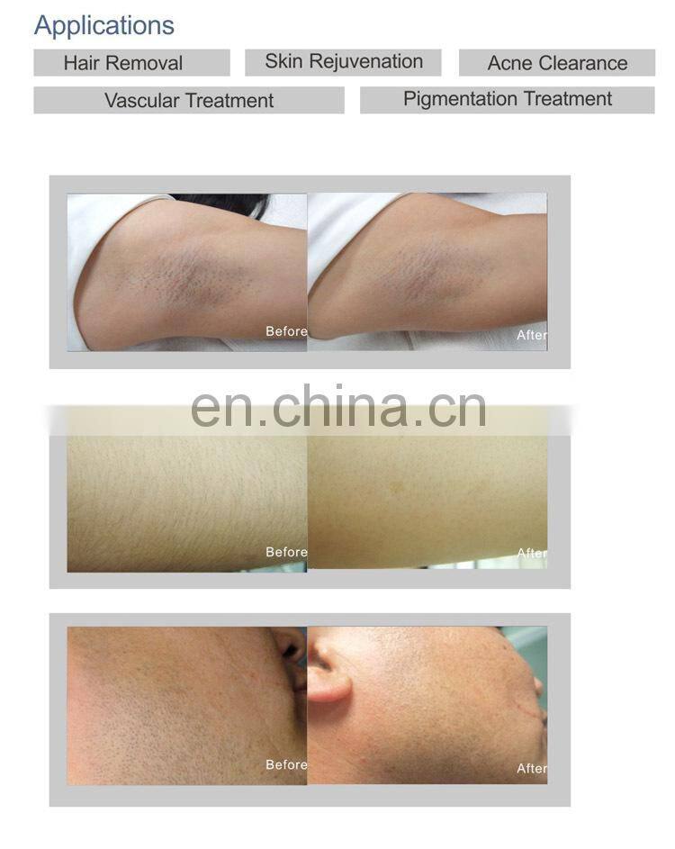 GSD Vertical IPL SHR Machine for hair removal/xenon ipl lamp