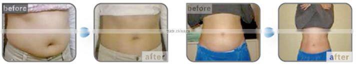 Nubway cryotherapy portable cryo machine