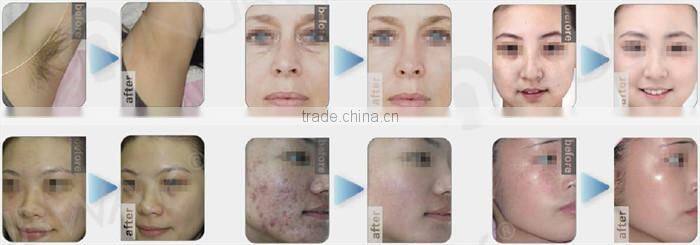 Factory direct supply- Professional IPL laser hair removal beauty machine