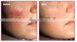 2016 best selling professional laser hair removal for hair removal