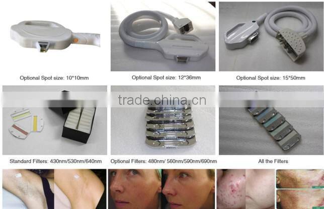 Beijing portable ipl hair removal equipment manufacturers looking for agent