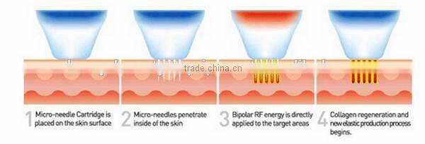 RF fractional microneedle radiofrequency