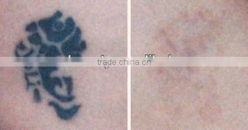 Mini style nd:yag laser tattoo removal D006