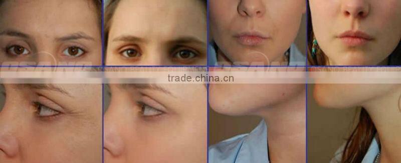 Professional Cooling RF Face Lifting Machine For Skin Care cryo rf portable