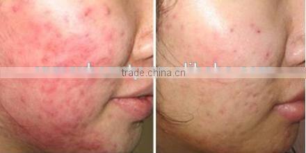 Meso Microneedle Pen/ Auto Derma Micro Needle Pen derma pen CE(11 microneedle)