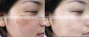 Hot selling !!! fractional co2 laser sun-damaged skin