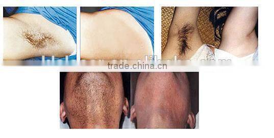 Pain-free diode laser hair removal machine price/laser hair removal machine for sale/permanent hair removal