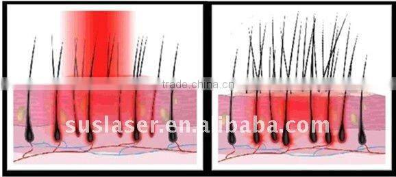 Hot Sale Best Price Red Light LED Machine For Hair Loss Treatment In India BL-002