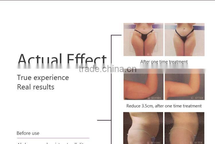 2016 ultrashape hifu body slimming machine / liposonic machine / ultrasonic ultrasound liposuction equipment for weight loss