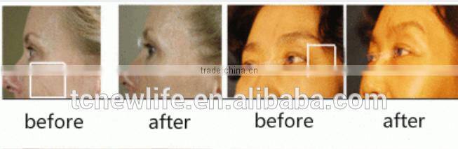 NL-M400 Hot ! Portable No Needle Mesotherapy Ultrasonic Electroporation Face Lifting Skin care Beauty Machine