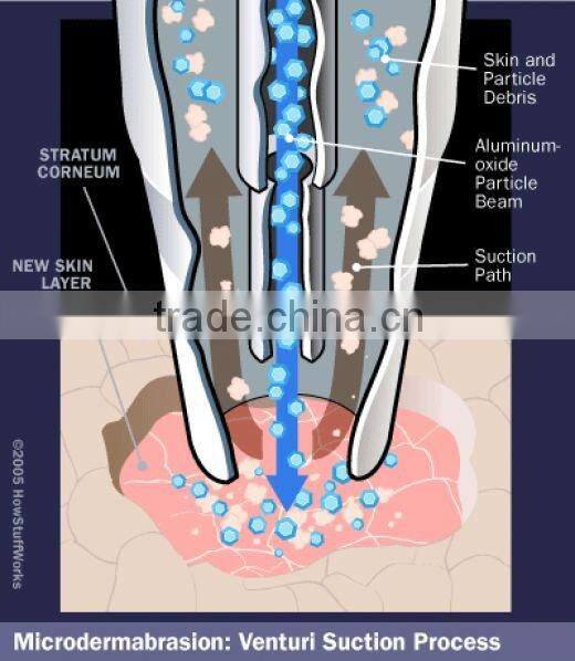 aluminum oxide microdermabrasion crystals