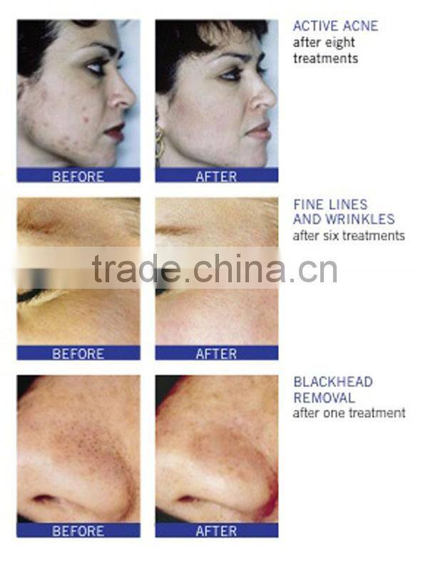 aluminum oxide microdermabrasion crystals