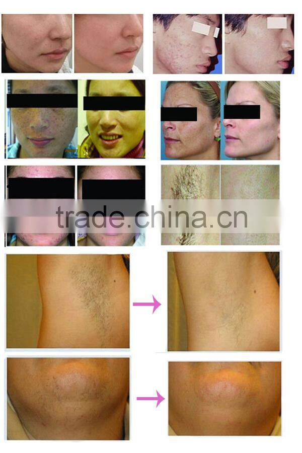AYJ-OPT-B promotion product skin Rejuvenation ipl power for beauty centre
