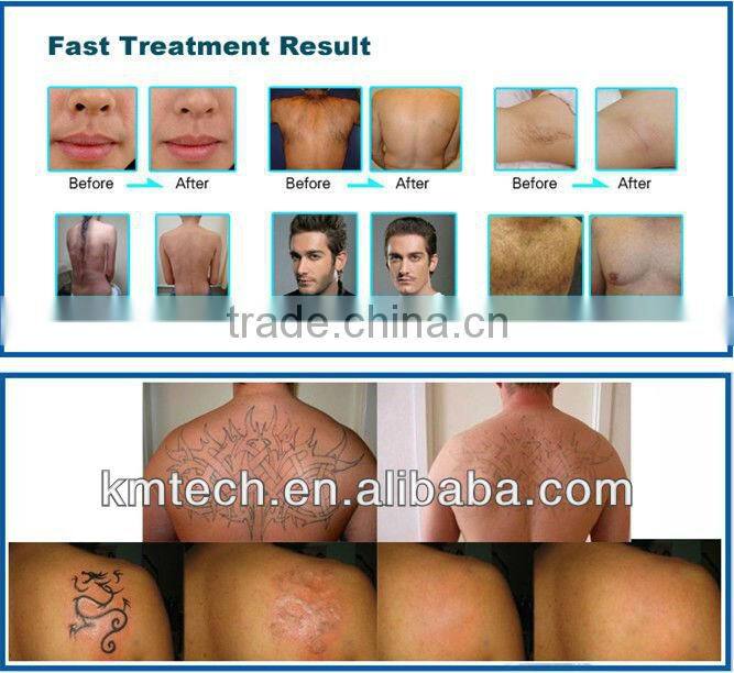 professional aft hair removal machine