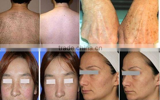 Latest Multi-functional IPL machine for hair reomval treatment with operation video (FB-AP-TK)