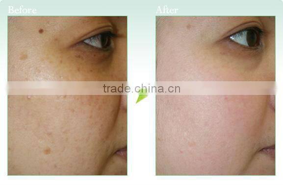 skin rejuvenation elight/ at home skin tightening machine C005