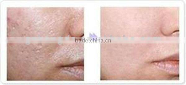 Permanent hair removal machines for skin rejuvenation beauty machine BD-J005