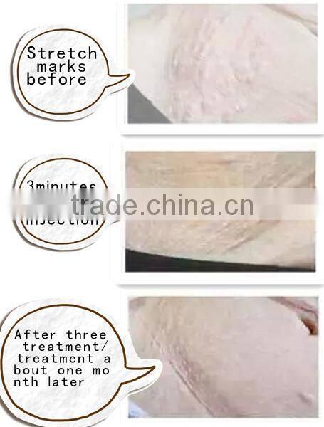 2015 hottest CDT CO2 carboxy therapy machine with free gases/needles/filters