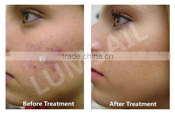 Skin care pdt photon led skin