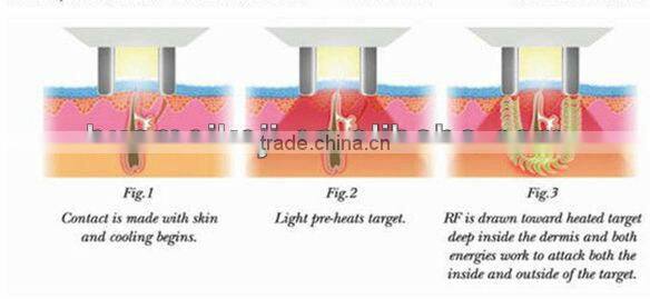portable elight/rf/iplmachine with leasing function with optional trolley