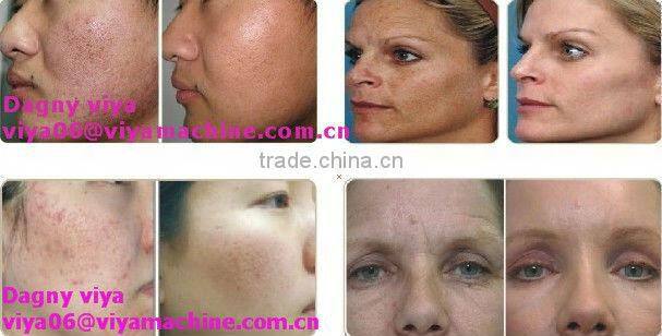 VY-V500 Newest rf needle fractional for skin refresh
