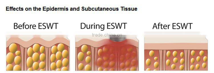 portable extracoroporeal Acoustic shock wave therapy in physiotherapy