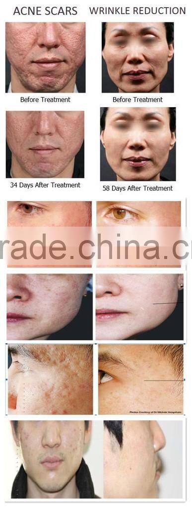 Best Selling rf fractional micro needle portable