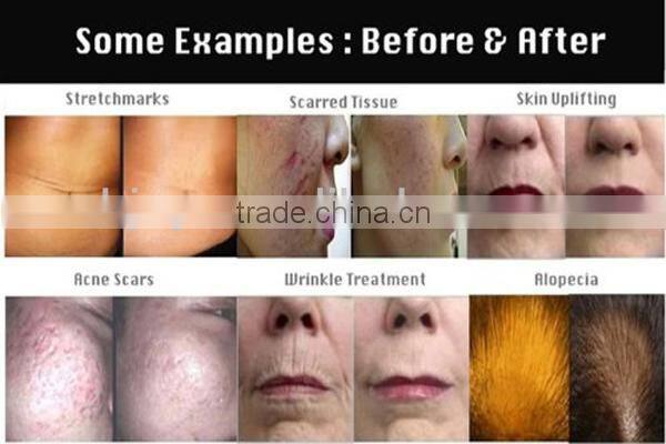 zgts derma roller zgts titanium derma roller zgts