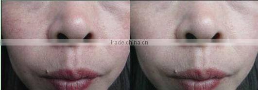 removal of lesions of the capillaries