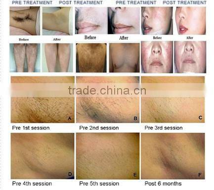 808nm laser diode price/cheap laser hair removal machine/laser diode 50w
