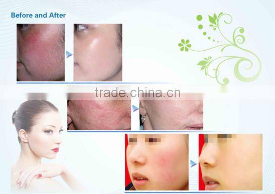 Super star products! the latest spider vein removal machine/ spider vein removal/laser spider vein removal