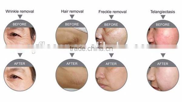 Best Newest!! 2 years warranty!!! 3 in 1 hair removal shr ipl machine/shr ipl for salon