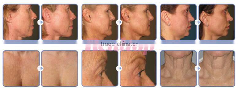 Portable hifu machine high intensive focus ultrasonic knife facial care skin tightening ultra age hifu face lift machine