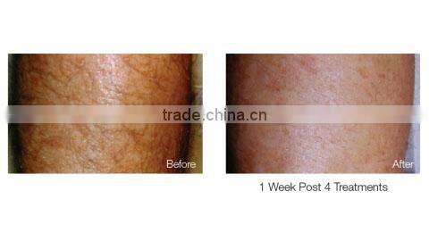 LED therapy infrared laser hair loss