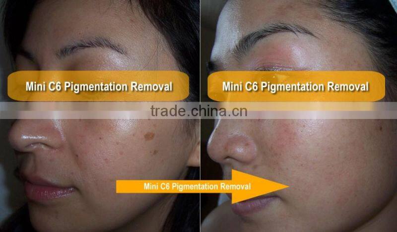 ND yag laser modules / ND yag laser tattoo removal machine