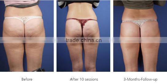 2016 Best Fast Pain Relief Cellulite Removal Shock Wave Acoustic Wave Machine