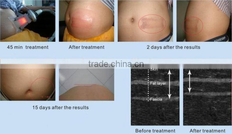 freeze fat machine / freeze fat / cryotherapy fat freezing device