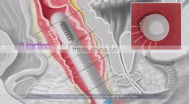 2017 Vaginal Tightening Machine China Supplier 5000 Times HIFU for Sale