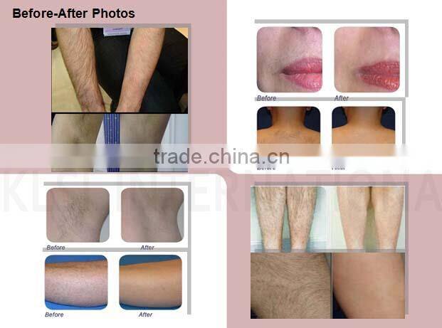 KLSi Beijing 808nm Diode Laser Hair Removal System